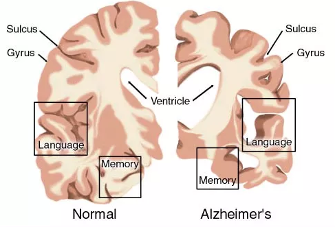 AD药物研发明状：辉瑞、礼来、百健、诺华、强生……