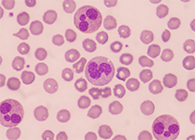 一种神秘颗粒被发明了！它能否成为败血症早筛标记物？？？？？