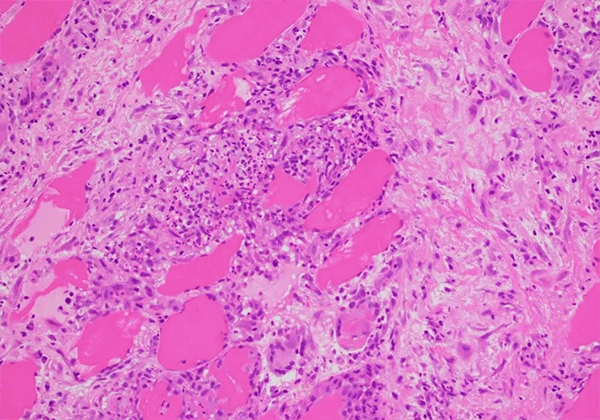 【旋乐吧spin8助力】治疗结节病的KBMAB-16获FDA批准临床